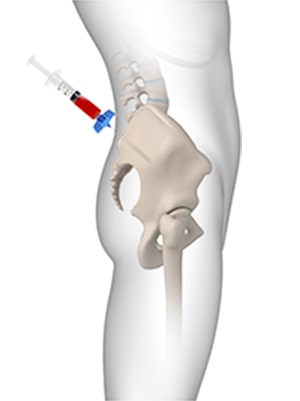 BMAC - Bone Marrow Aspirate Mesenchymal Regenerative Cell Injections