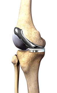 Custom-fitted Partial Knee Arthroplasty