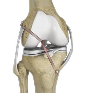 Knee Ligament Reconstruction