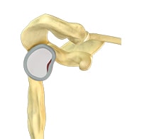 Labral Repair