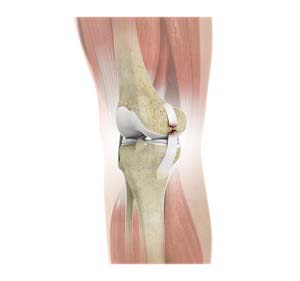 Medial Collateral Ligament (MCL) Tear Reconstruction – Dr Mukhi's Raj  Hospital