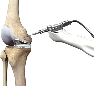 Pa Joint Replacement