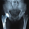 Transient Osteoporosis of the Hip